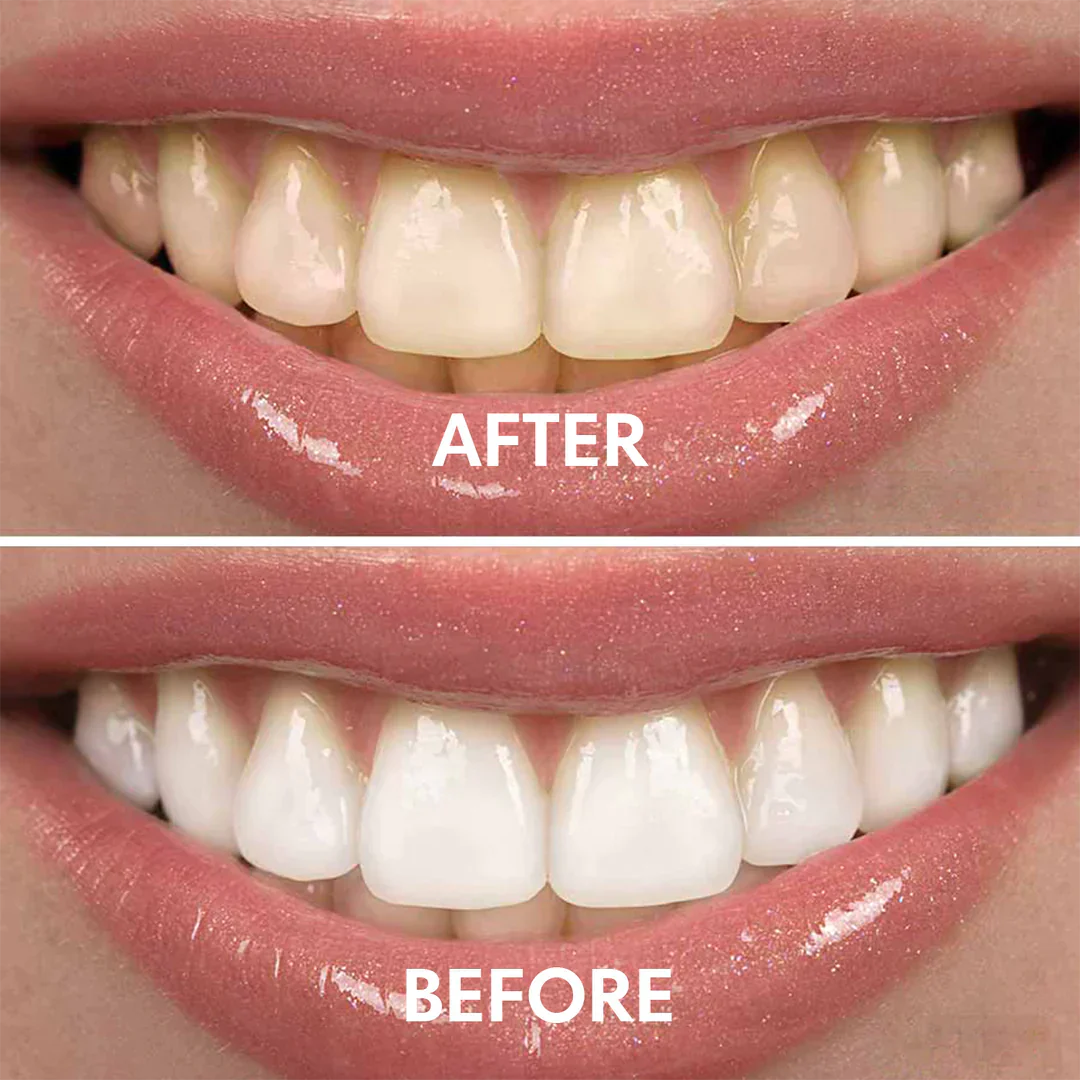 V34 Teeth Whitening Mousse